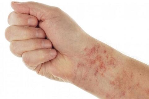 allergies caused by parasites in the body