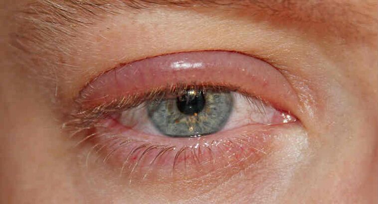 Demodicosis of the eyelids